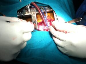 heart transplant in indore